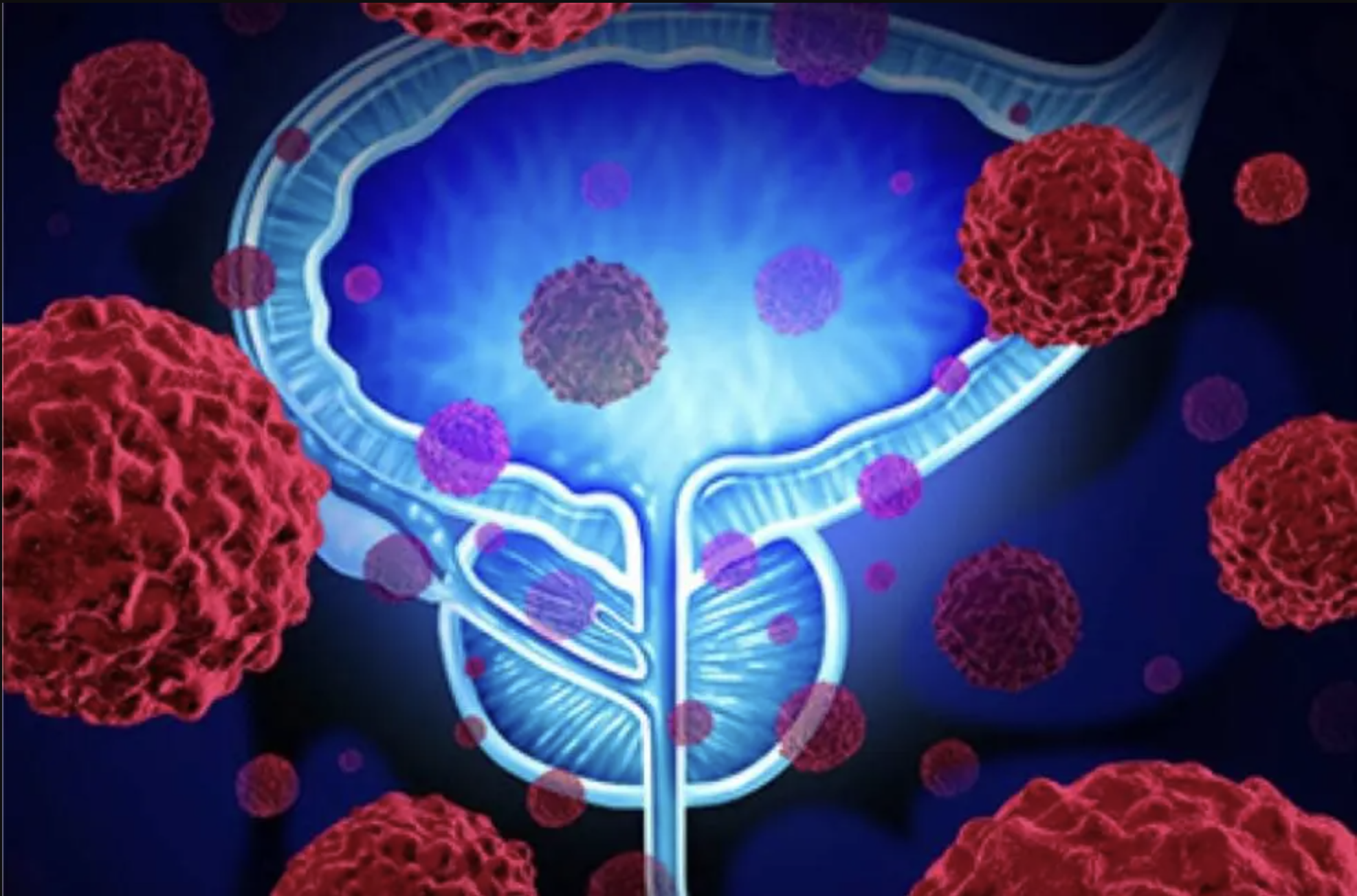 AI Tool May Help Some Prostate Cancer Patients Avoid Hormone Therapy